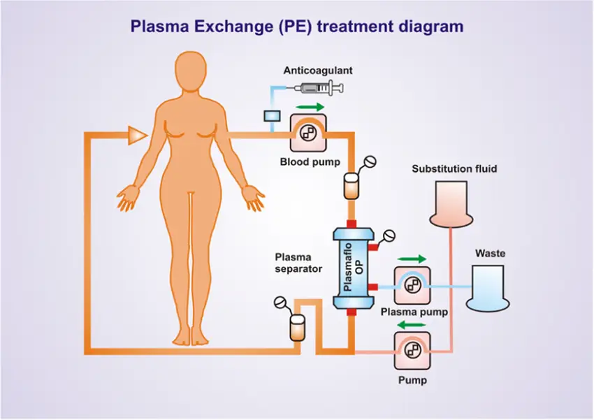 Therapeutic-plasma-exchange